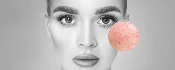 Couperose Laserbehandlung Linz - Leonding